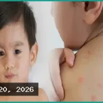হাম উপসর্গে আরও ৭ শিশুর মৃত্যু: উদ্বেগ