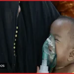 হামের উপসর্গে আরও তিন শিশুর মৃত্যু, মোট প্রাণহানি ৬৮৯