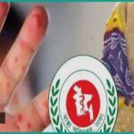 দেশে হাম ও উপসর্গে আরও ৫ শিশুর মৃত্যু
