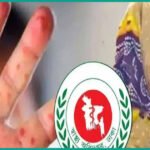 দেশে হাম ও উপসর্গে আরও ৭ শিশুর মৃত্যু