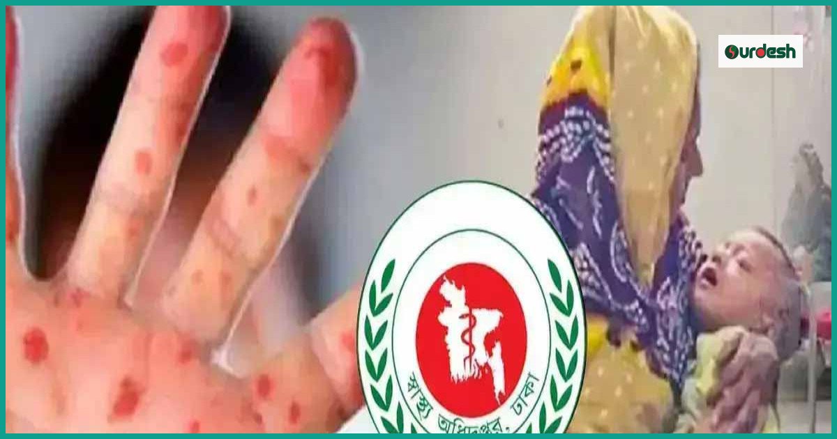 দেশে হাম ও উপসর্গে আরও ৭ শিশুর মৃত্যু