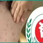 হামের উপসর্গে আরও তিন শিশুর মৃত্যু, নতুন আক্রান্ত ৯৪৭