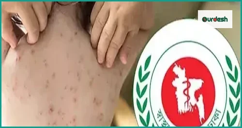 হামের উপসর্গে আরও তিন শিশুর মৃত্যু, নতুন আক্রান্ত ৯৪৭