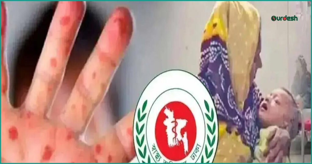 দেশে হাম ও উপসর্গে আরও ৭ জনের মৃত্যু