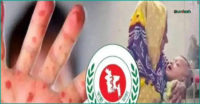 দেশে হাম ও উপসর্গে আরও ৭ জনের মৃত্যু