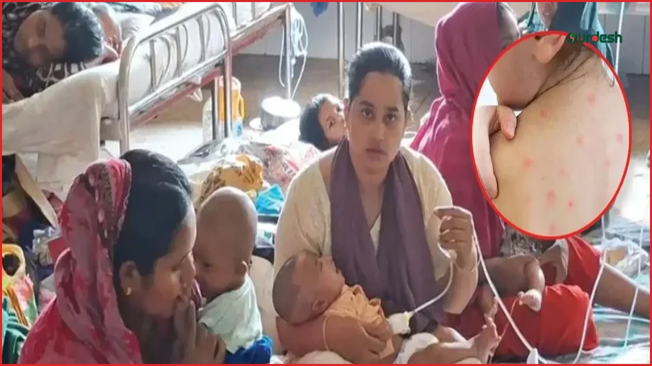 হামের উপসর্গে আরও চার শিশুর মৃত্যু, আক্রান্তের সংখ্যা ১ লাখ ১৭ হাজার ছাড়াল