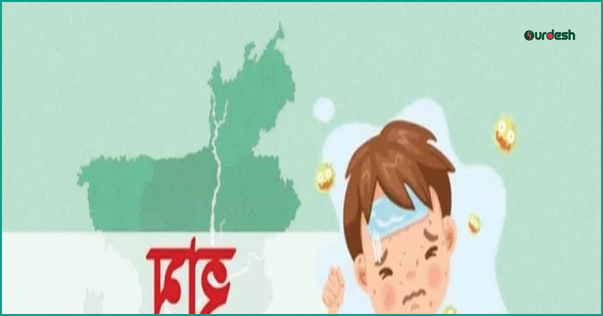 হামের প্রকোপ: ২৪ ঘণ্টায় আরও ৮ শিশুর মৃত্যু, আক্রান্ত ১,১৭১