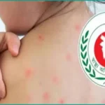 হামের প্রকোপ: ২৪ ঘণ্টায় প্রাণ হারাল আরও ৬ শিশু