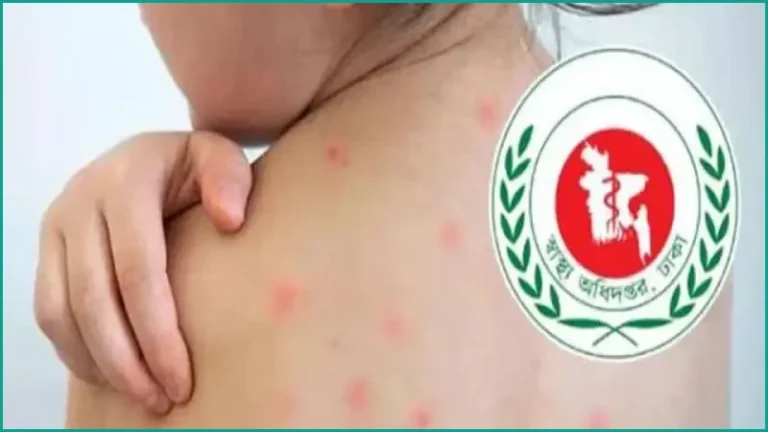 হামের প্রকোপ: ২৪ ঘণ্টায় প্রাণ হারাল আরও ৬ শিশু